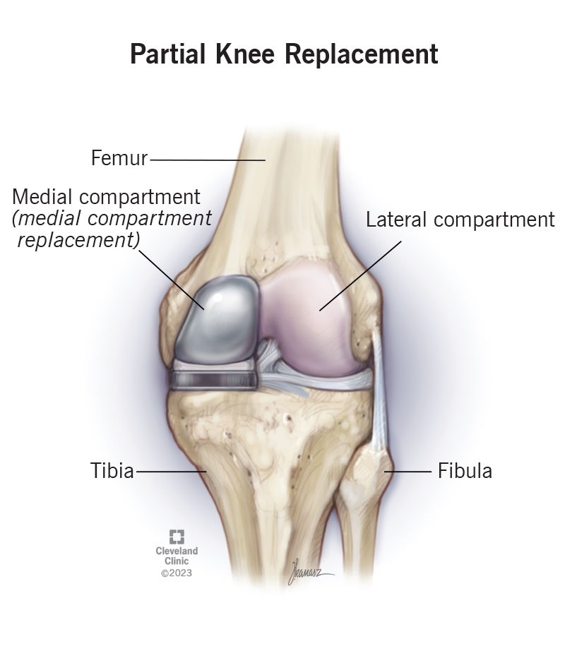 Partial Knee Replacement in Nagpur