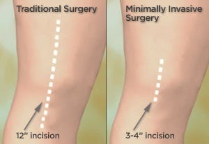 Small Incision Knee Surgery