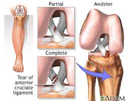 Best ACL Surgeon in Nagpur