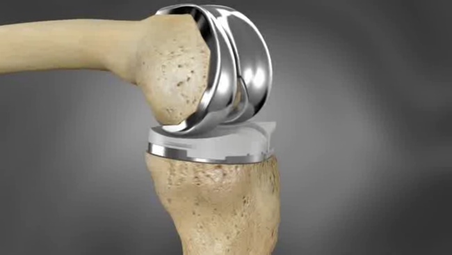 Total Knee Replacement nagpur