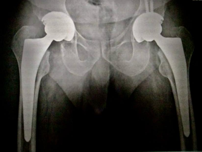 Xray after total hip replacement