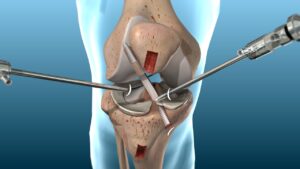 ACL tear is best treated by arthroscopic repair/reconstruction where magnified detailed image of knee is available and precise surgery is done using just small scar