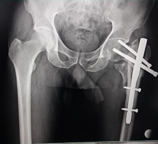 Best Total Hip Replacement Surgeon in Nagpur