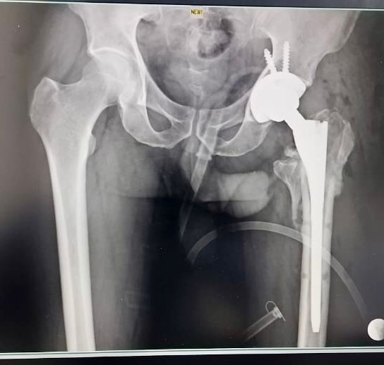 Total Hip Replacement in Nagpur